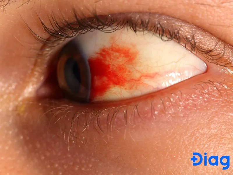 Bệnh võng mạc tiểu đường là biến chứng ở mắt ảnh hưởng đến thị lực