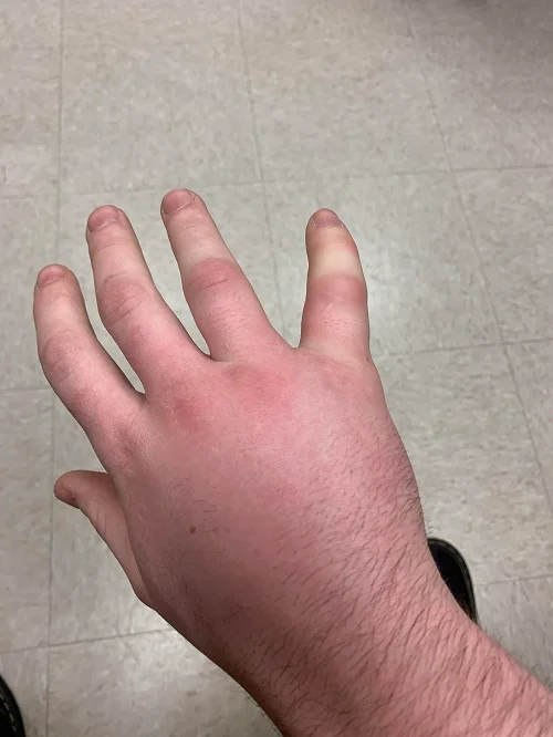 Rết cắn ngón tay: Đau đớn và hiểm nguy.