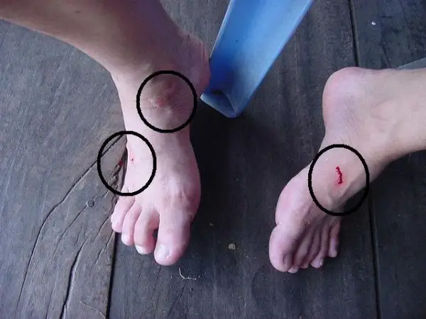 Nằm mơ thấy vắt bám chân: Giải đáp lo lắng và hướng hóa giải 6 Người gỡ vắt rừng khỏi chân.