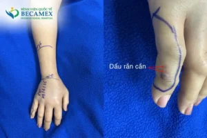 Rắn cắn tay: Cảnh báo nguy hiểm