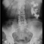 Sỏi san hô ở thận trái trên phim chụp X quang