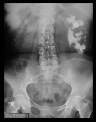 Sỏi San Hô Đài Bể Thận: Nhận Biết Biến Chứng Và Cách Điều Trị 2026 15 Sỏi san hô ở thận trái trên phim chụp X quang